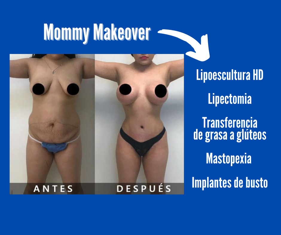 Mommy makeover